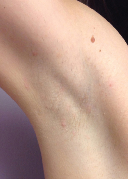 bare-hr-laser-hair-removal-underarms