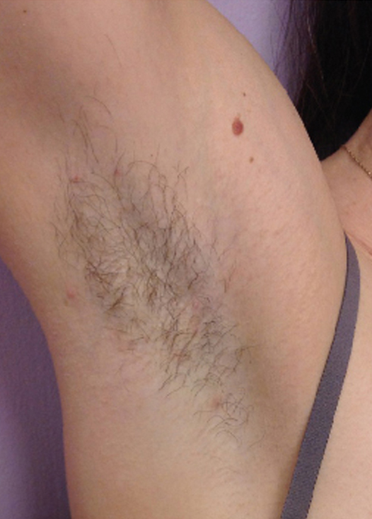 bare-hr-laser-hair-removal-underarms