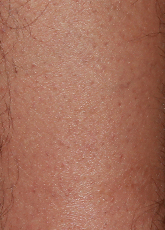 bare-hr-laser-hair-removal-underarms