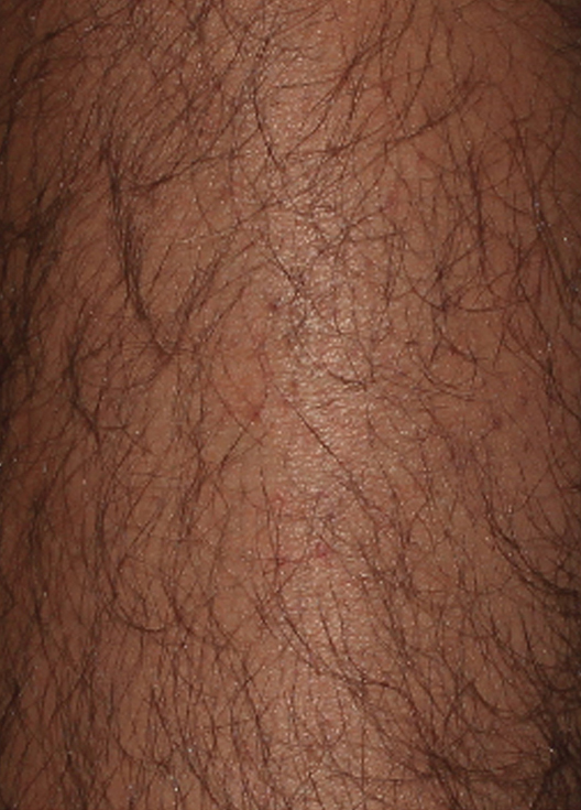 bare-hr-laser-hair-removal-underarms